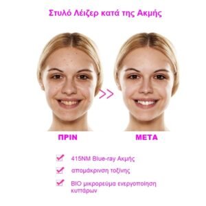 προσωπο-stylo-leizer-akmis-kokkiniles-sysfigksi-dermatos-laser-akmis